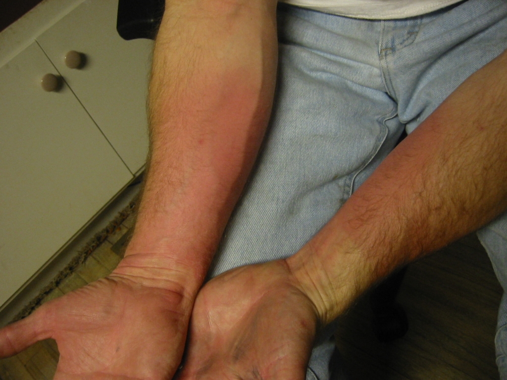 Welding Sunburn